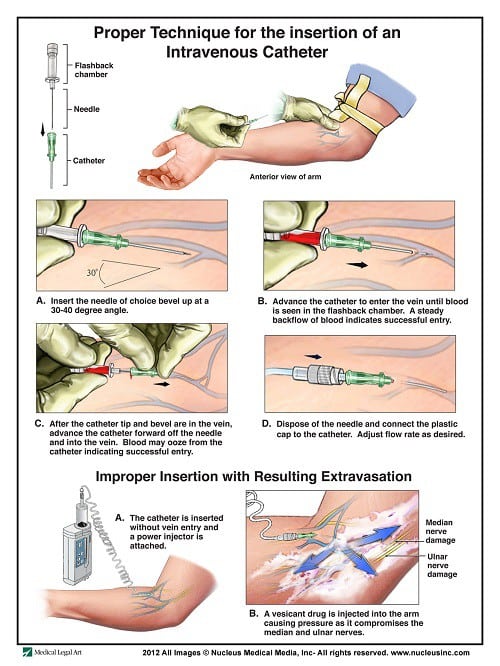 55 IV Therapy Tips And Tricks How To Hit The Vein In One Shot