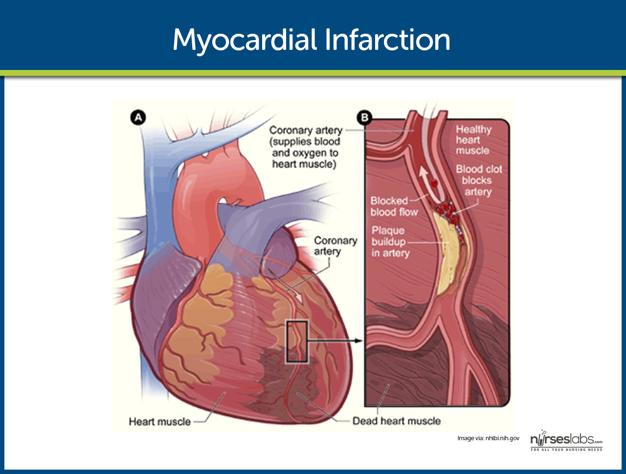 myocardial-infarction-nursing-care-management-and-study-guide