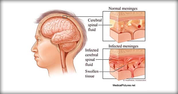 meningitis brain infection