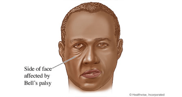 Bell's Palsy Nursing Management and Interventions - Nurseslabs