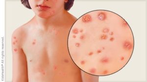 Chicken Pox. Image via. kidshealth.org