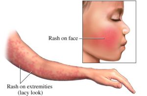 Fifth disease rash. 