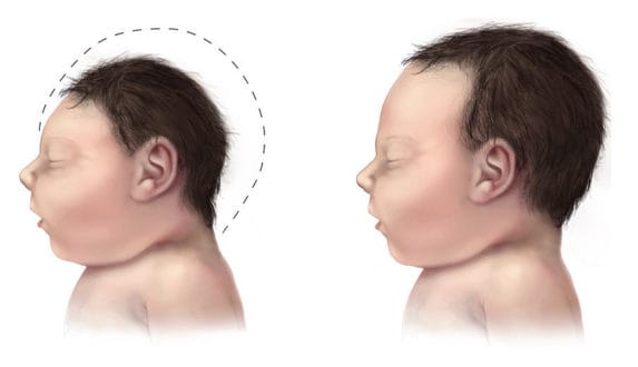 Microcephaly (left) compared to normocephalic neonate.