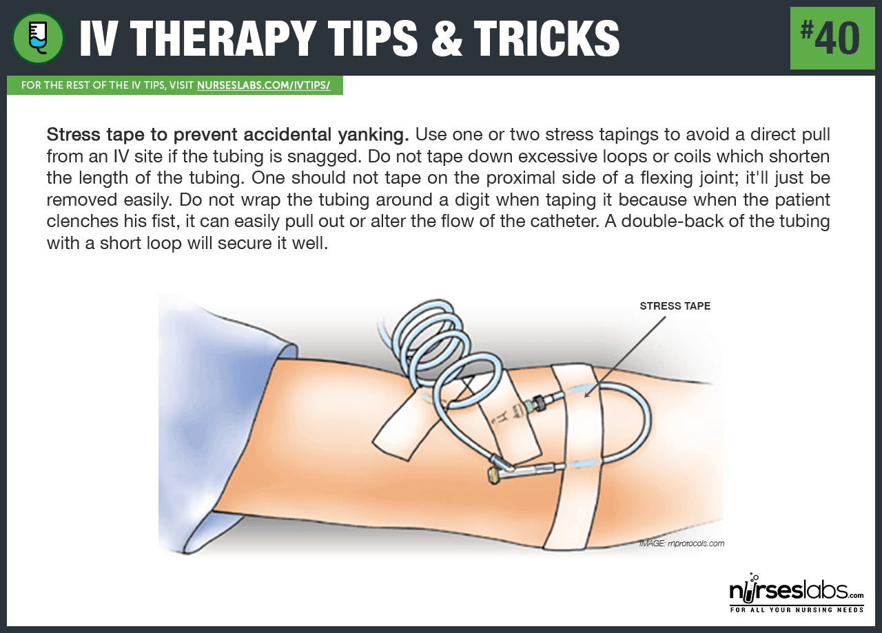 Starting an IV Tips and Tricks: Zabezpieczanie cewnika przez dodanie pętli naprężającej.