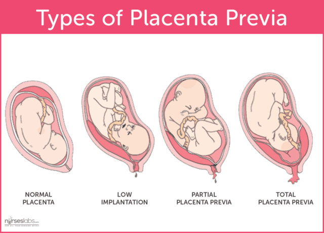 placenta-previa-low-lying-placenta-placenta-position-type-of