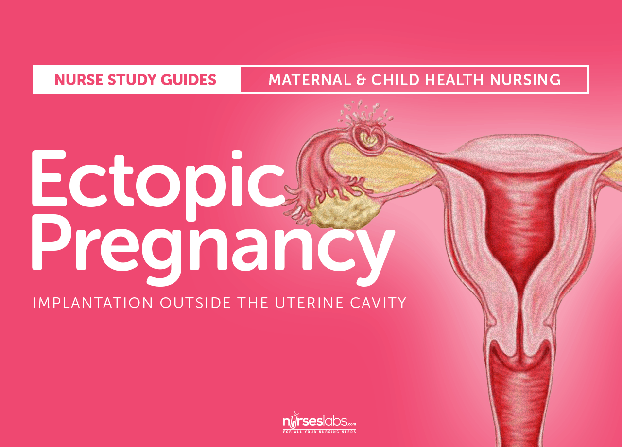 case study on ectopic pregnancy