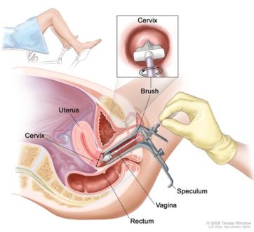 Papsmear