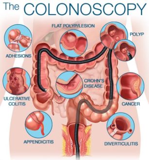 Colonoscopy