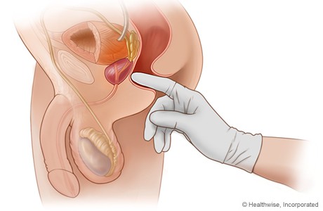 digital rectal exam