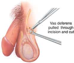 vasectomy