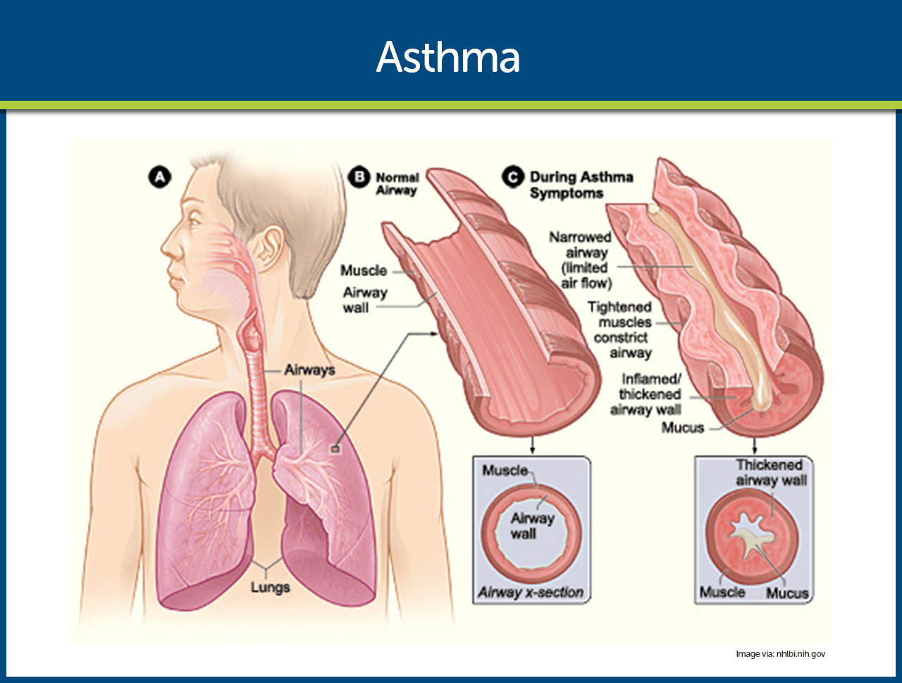 asthma-pathophysiology