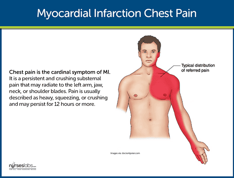 Myocardial Infarction: Nursing Care Management and Study Guide