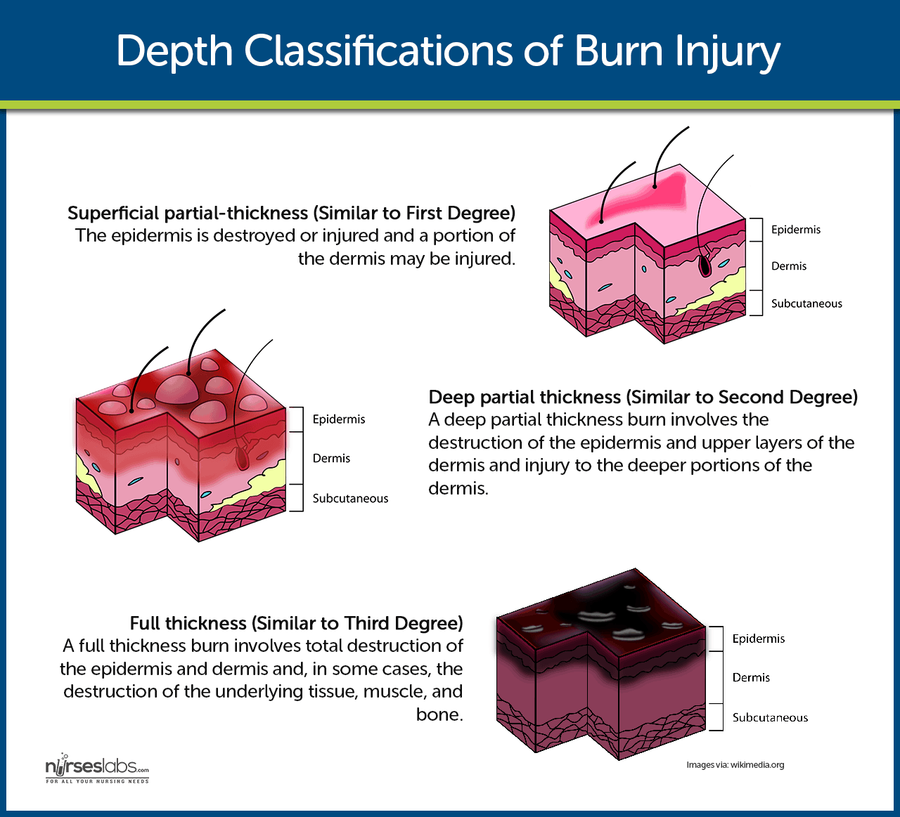 Classifications of Burn Injury By Depth