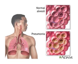 pneumonia-image