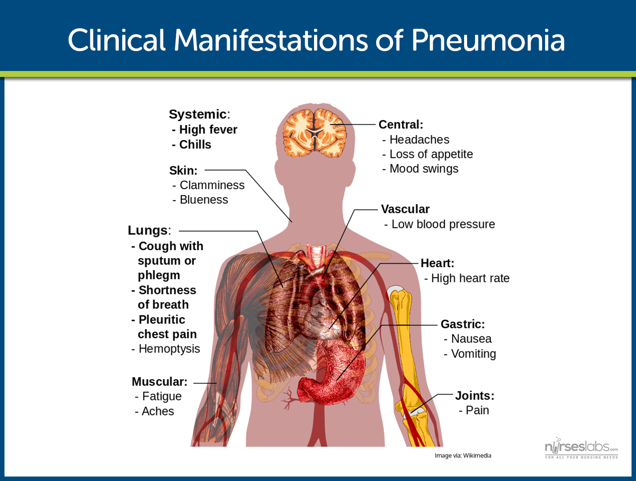 Clinical Manifestations of Pneumonia