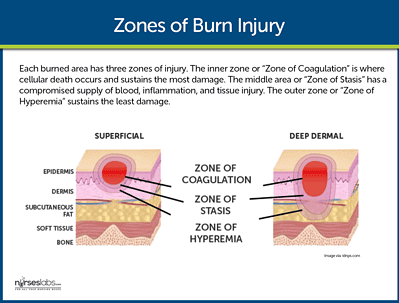 Burn Injury Nursing Care Management and Study Guide