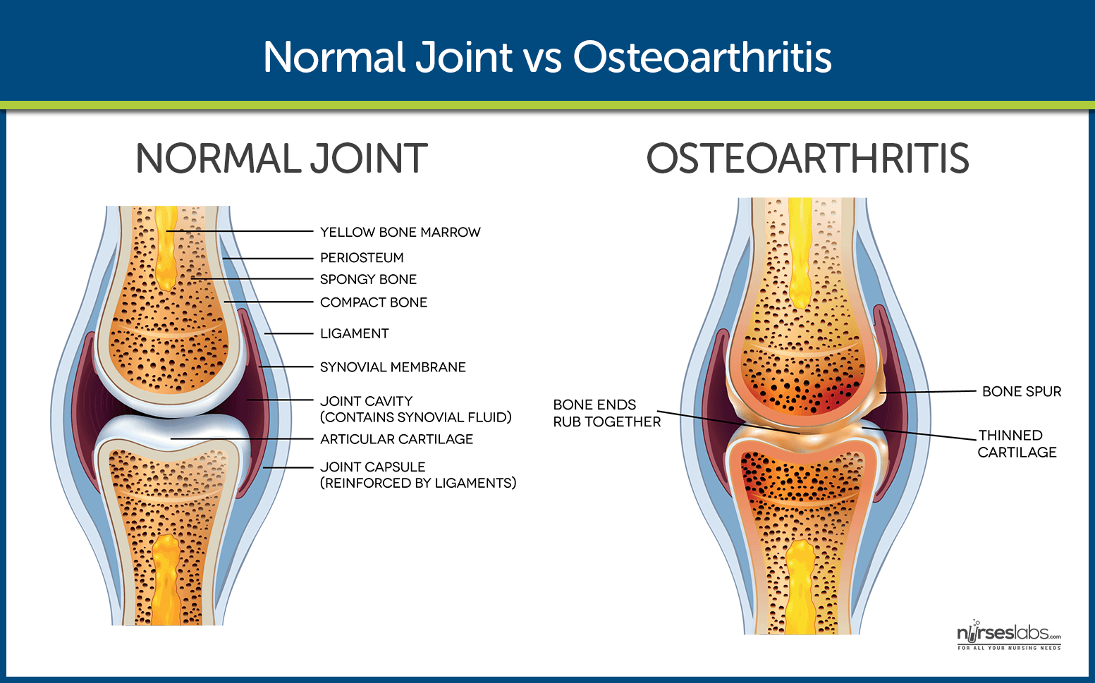 xray of normal hip joint vs osteoarthritic