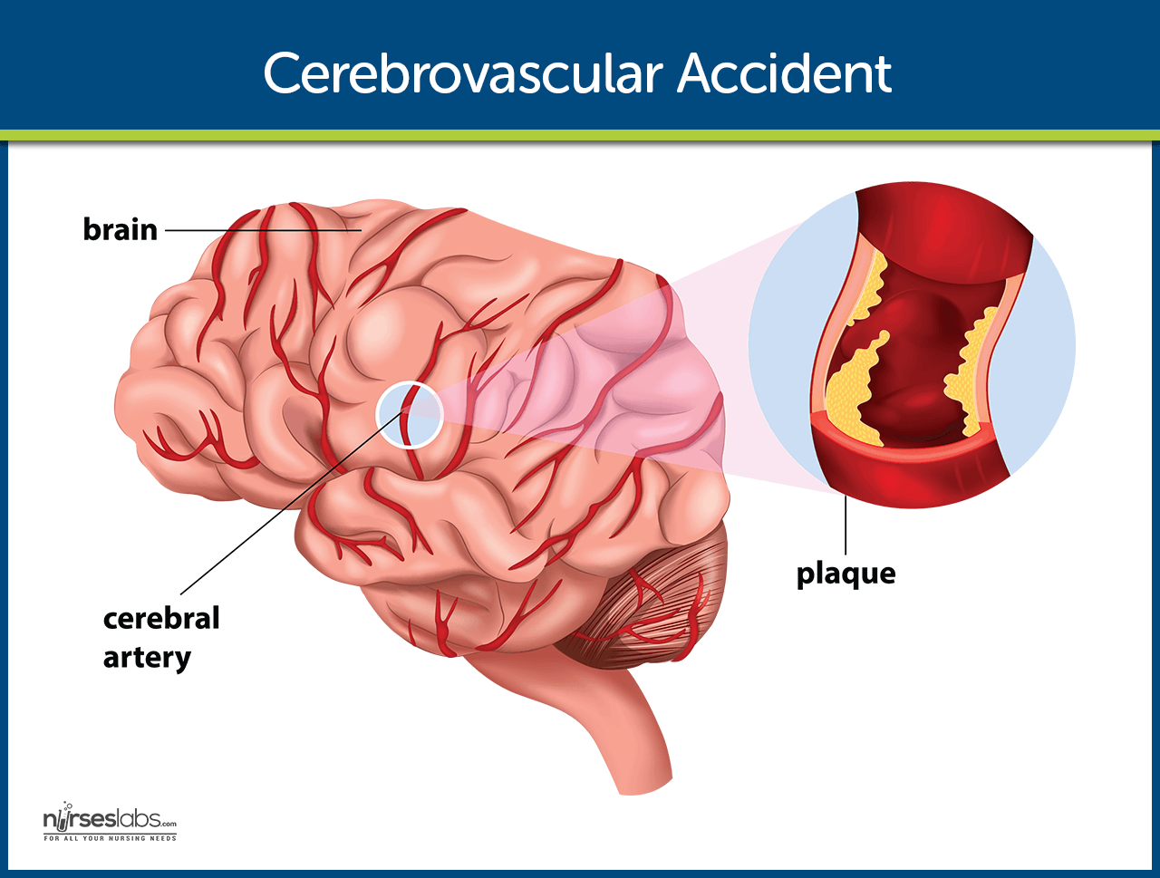 Cerebrovascular Accident Stroke Nursing Care And Management A Study Guide