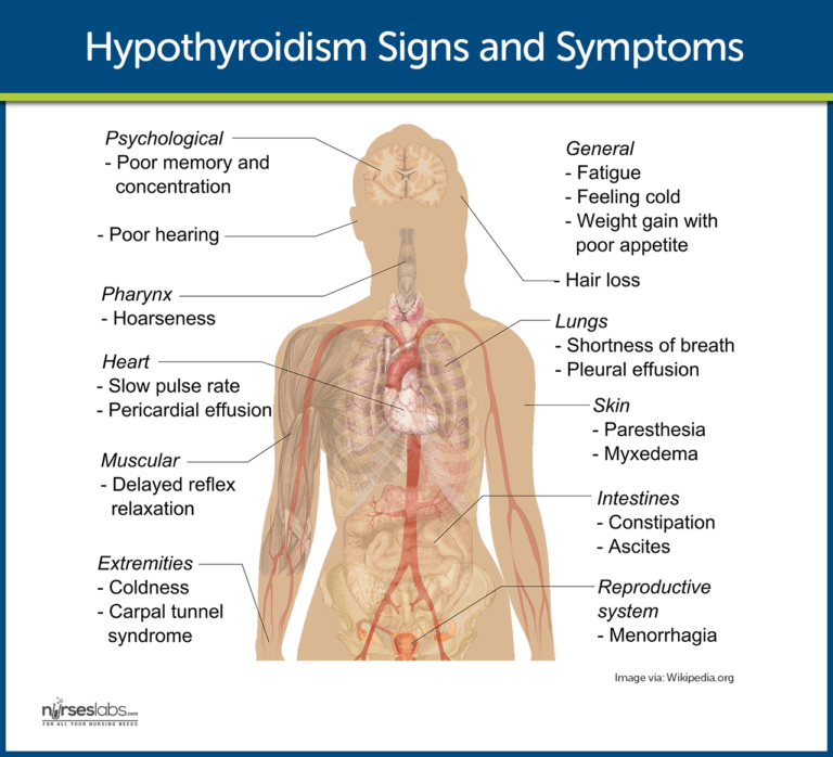 nursing case study hypothyroidism