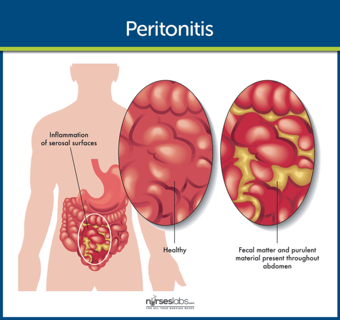Peritonitis Nursing Care Management and Study Guide