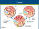 Cystitis Nursing Care and Management: Study Guide