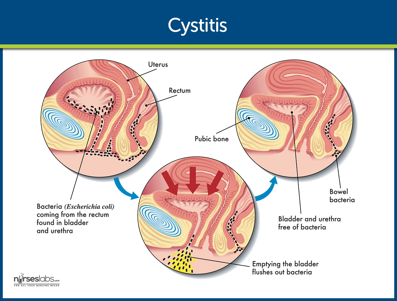 Cystitis Pathophysiology Nursing Care