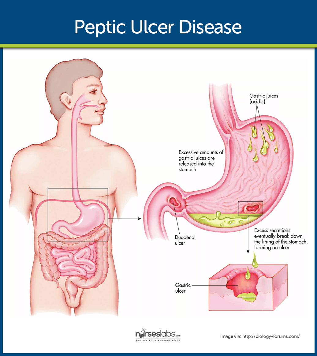 stomach ulcer pain location