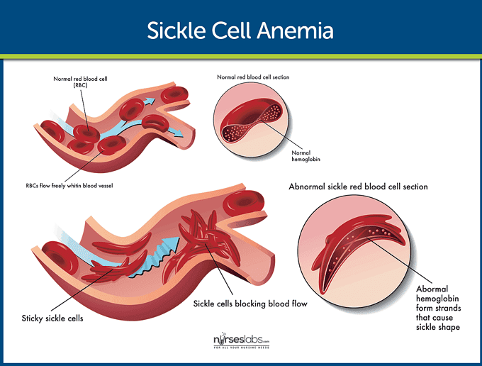 Sickle Cell Anemia Nursing Care and Management Study Guide
