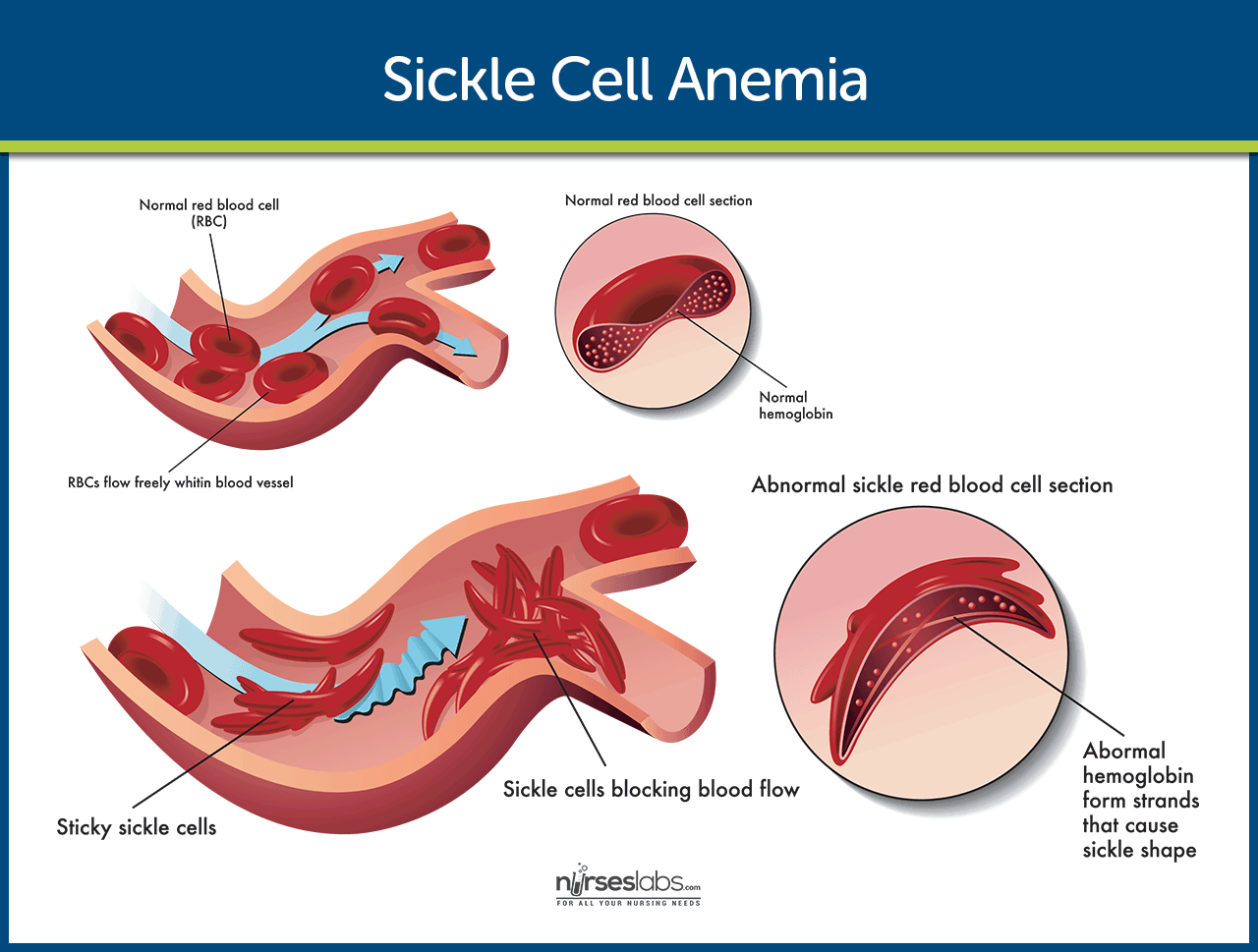 case study about sickle cell anemia