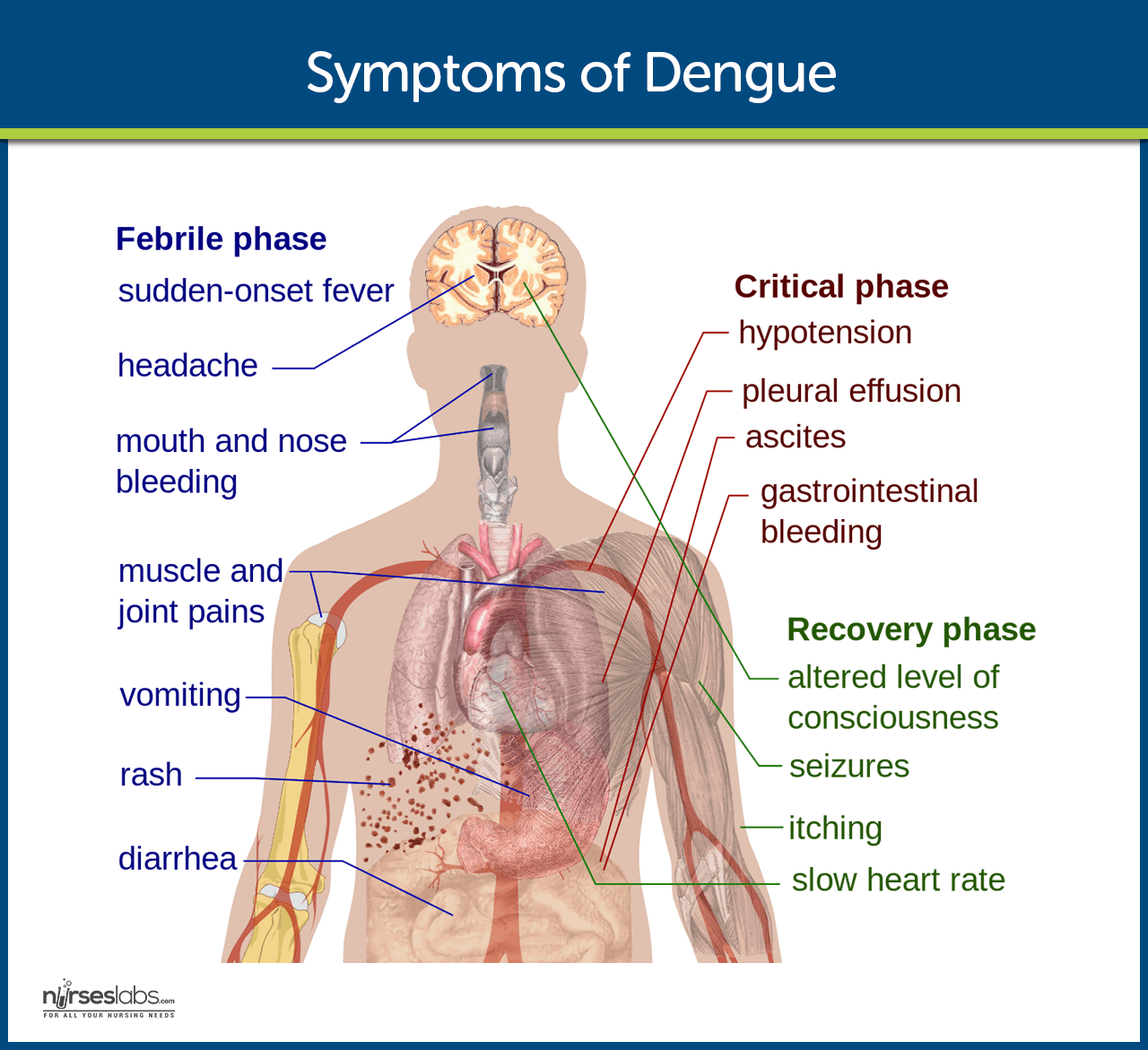 symptoms of dengue