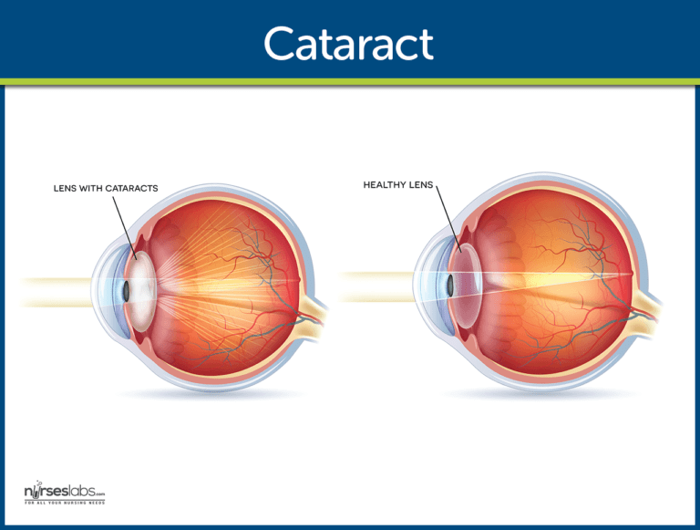 Cataract Nursing Care Management Study Guide for Nurses