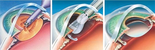 Phacoemulsification