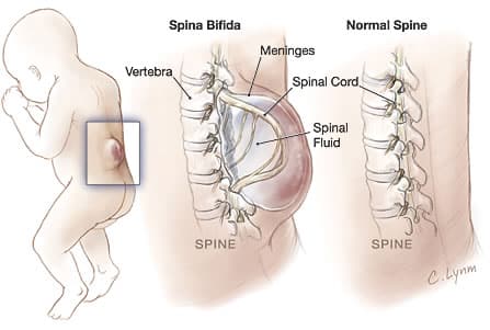 spina bifida occulta hair