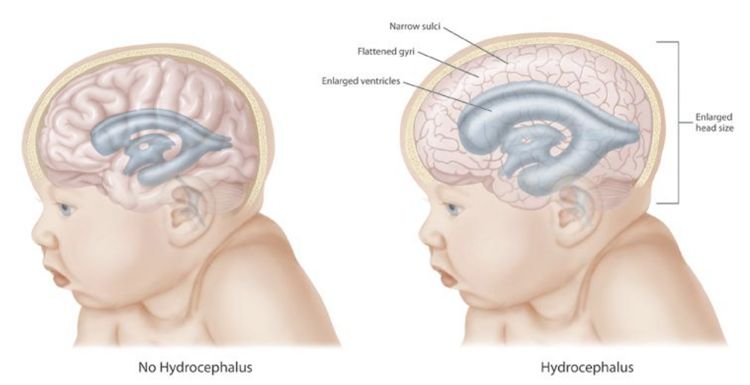 Effect of hydrocephalus in the brain and cranium. Image via: wikipedia.org