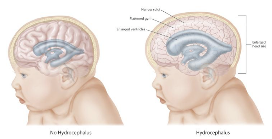 hydrocephalus in adults