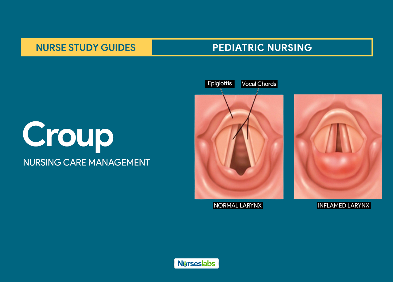 diagnosis what nursing Planning Care Syndrome Croup Nursing and Study Management: