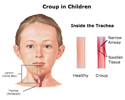 croup