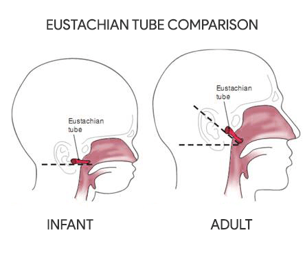 nursing case study on otitis media