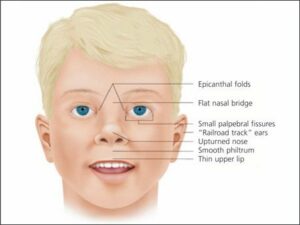 almond shaped eyes down syndrome