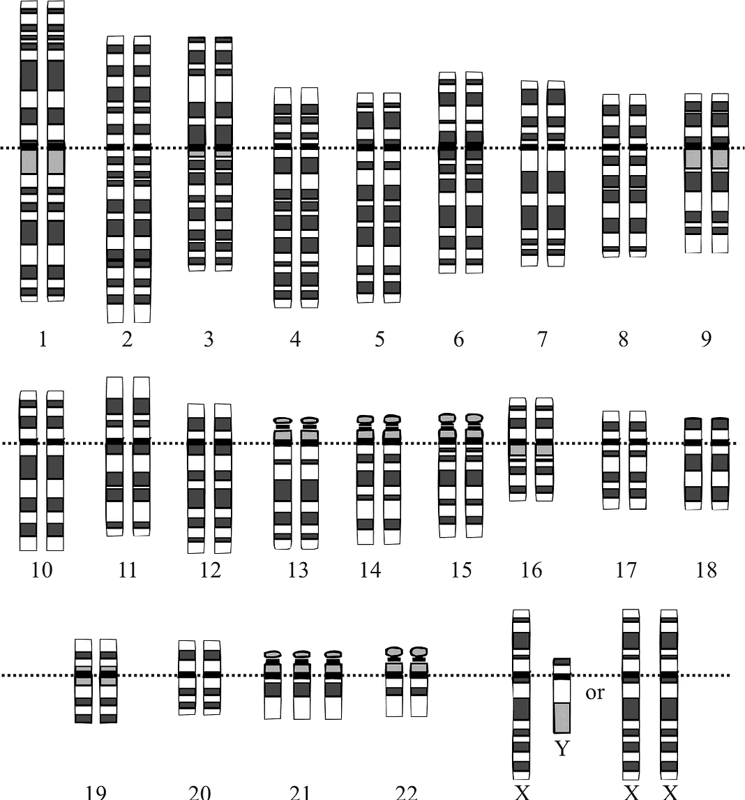 T21 Features Down Syndrome (Trisomy 21)