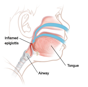 Epiglottitis Nursing Care Planning And Management