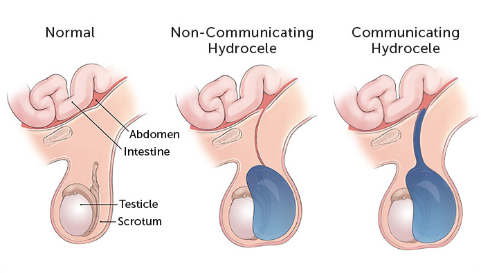 CRETO Scrotal Support use for vericocele and hydrocele helps in