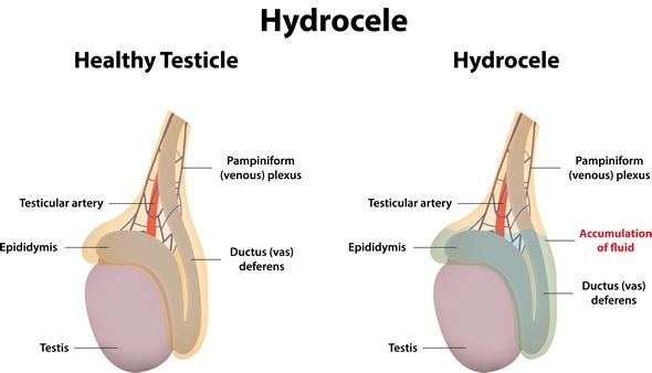 Hydroceles and Inguinal Hernia: Symptoms, Diagnosis & Treatment - Urology  Care Foundation