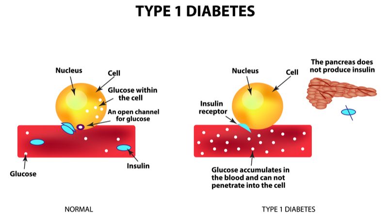 metabolism type 1 diabetes mellitus management part 1 case study