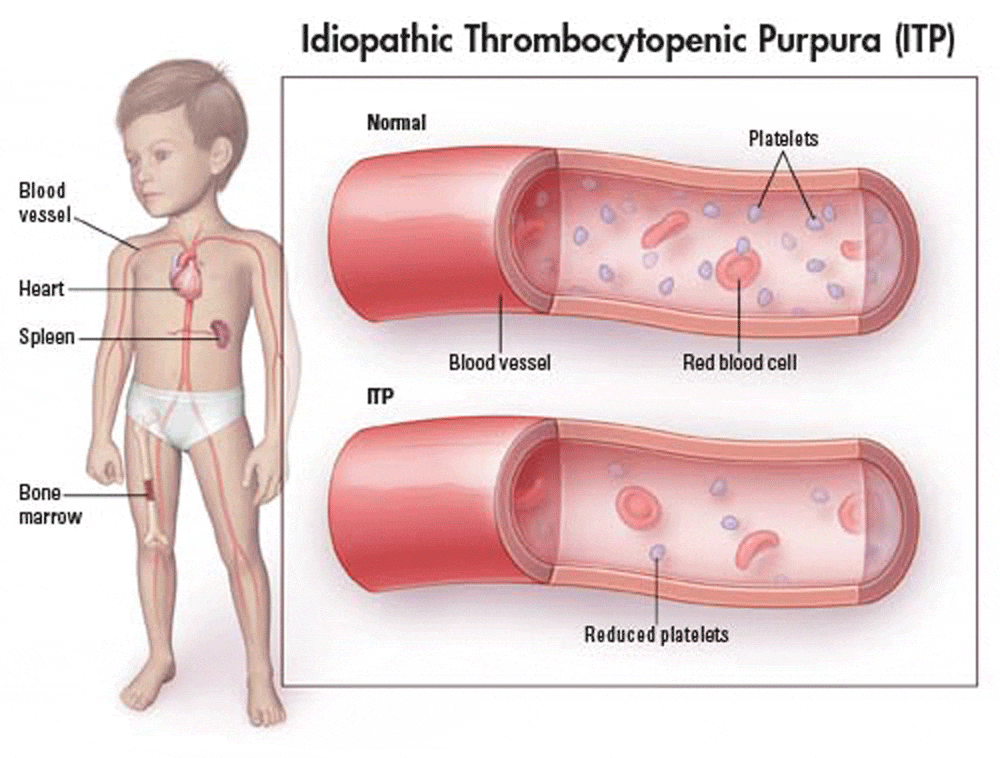 idiopathic thrombocytopenic purpura diagram