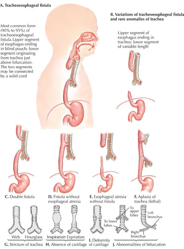 esophageal atresia repair