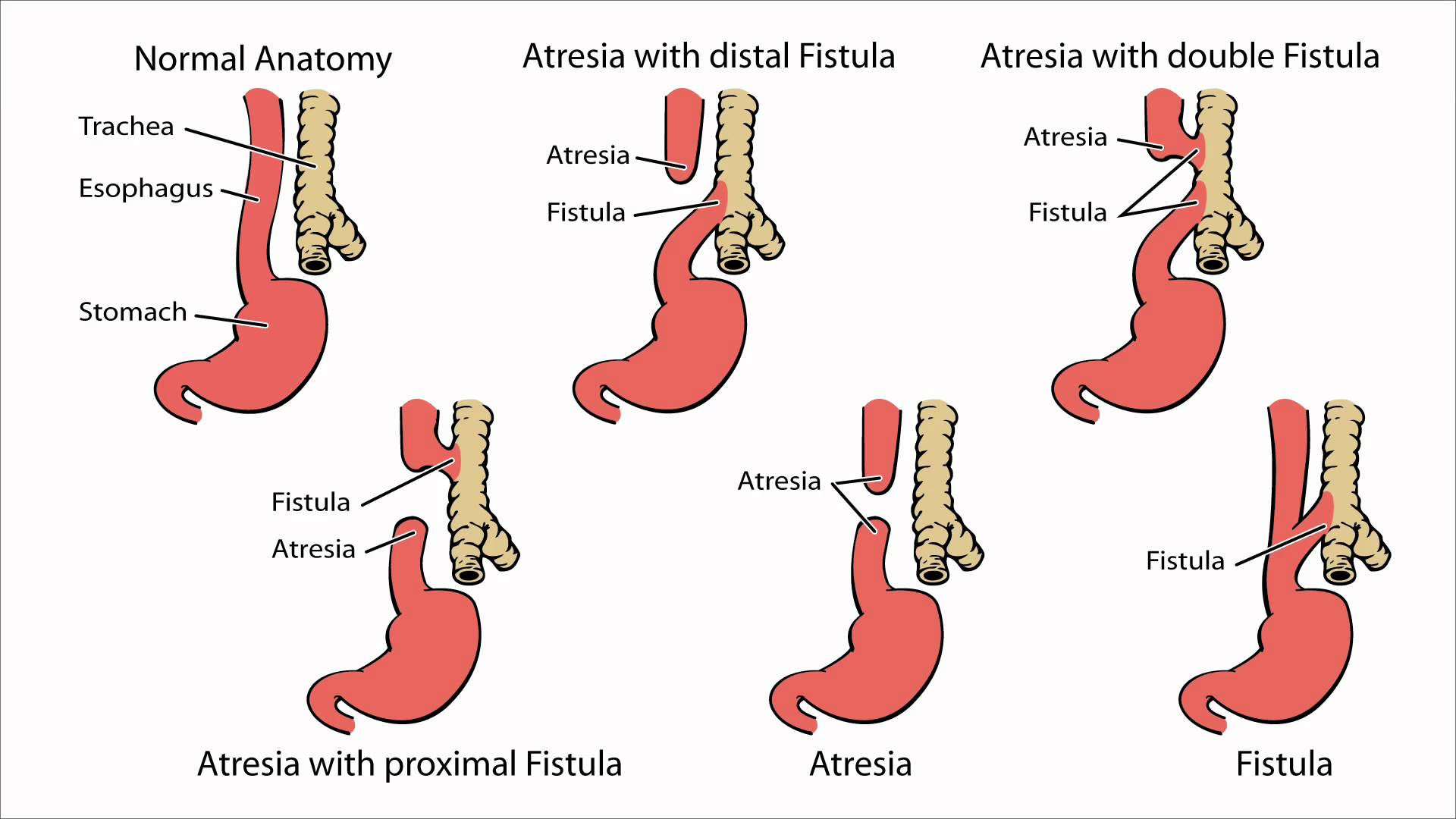 Tracheoesophageal Atresia Nursing Care Management Study Guide Nurseslabs