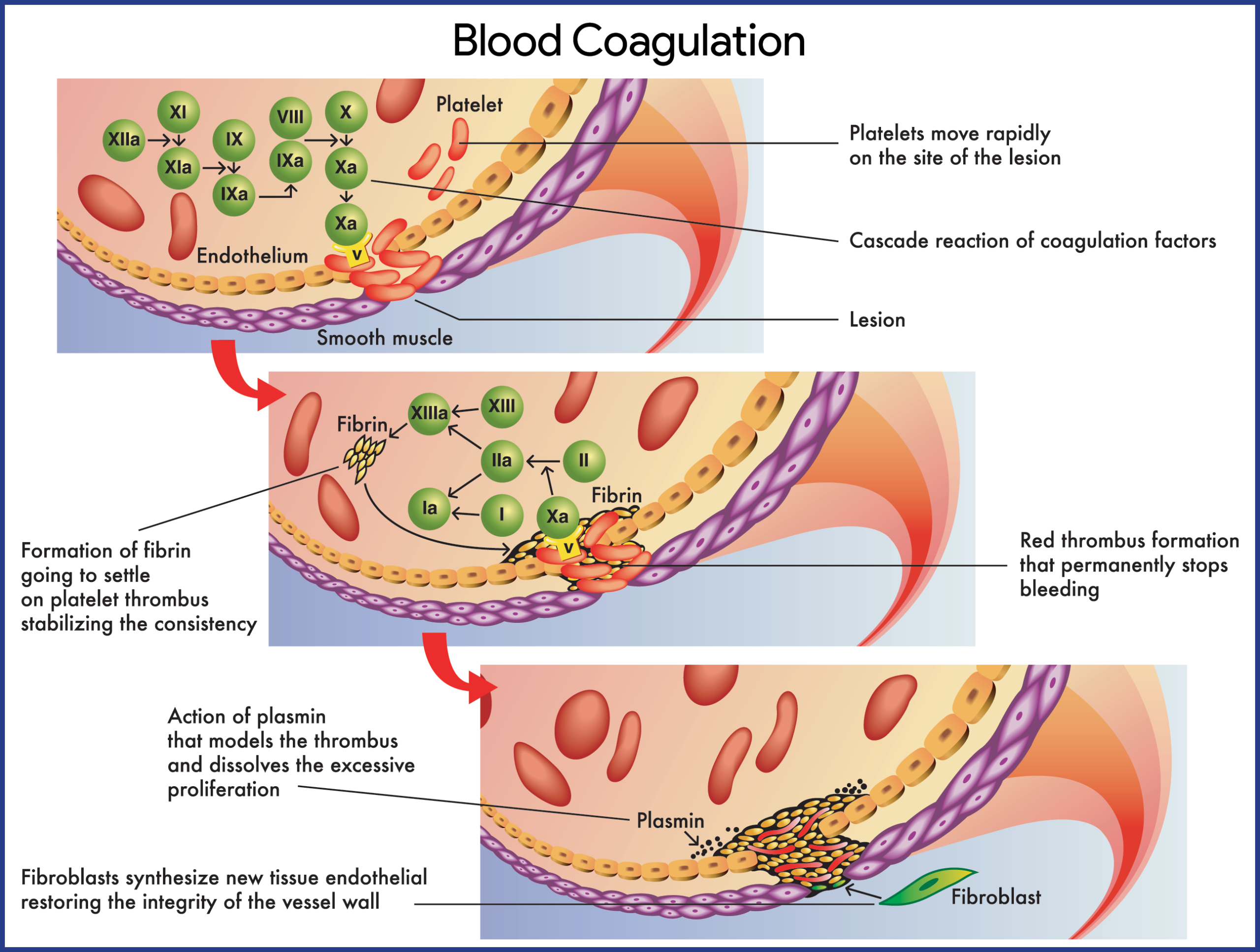 case study 3 hemophilia