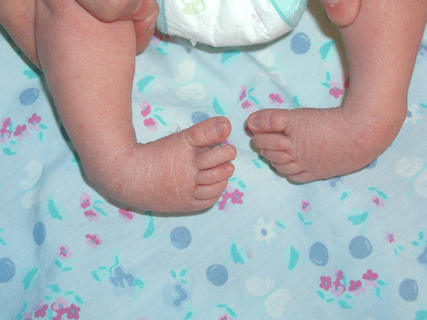 Congenital Talipes Equinovarus Clubfoot Nursing Care Management Nurseslabs