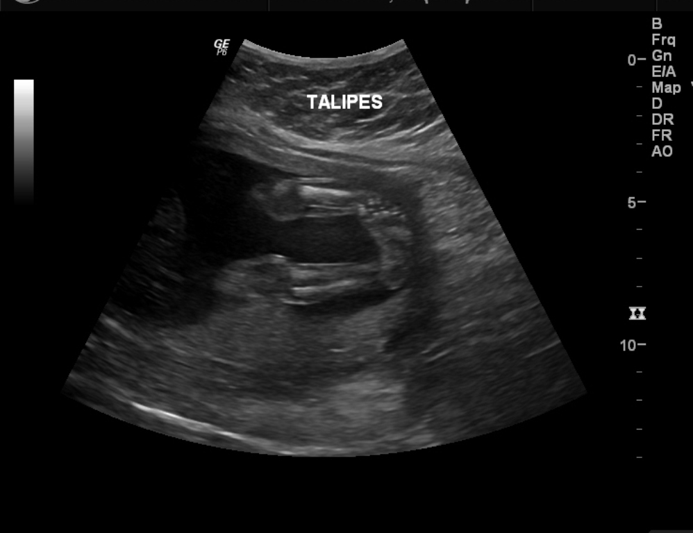 Congenital Talipes Equinovarus Nursing Care Management